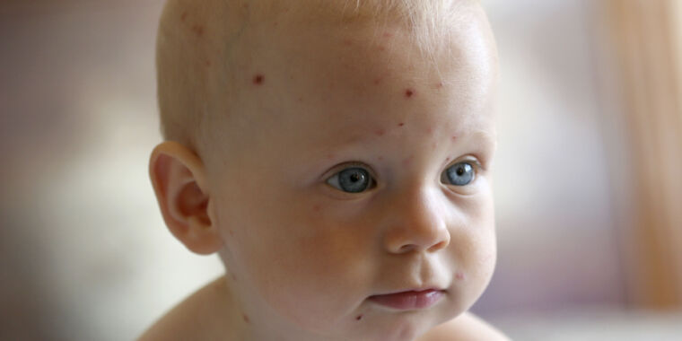 Chickenpox Overdiagnosed Due to Vaccination Success