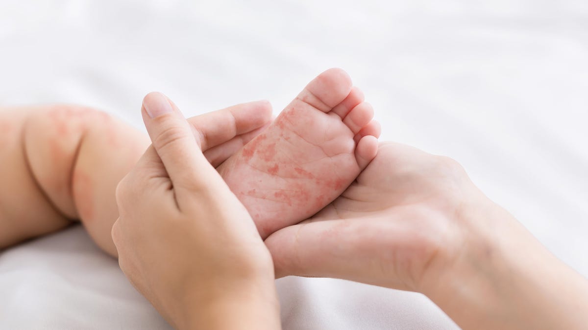 Measles Makes Unwelcome Return in U.S.